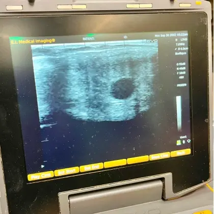 Ultrasound imaging display showing diagnostic scan results on medical equipment screen.